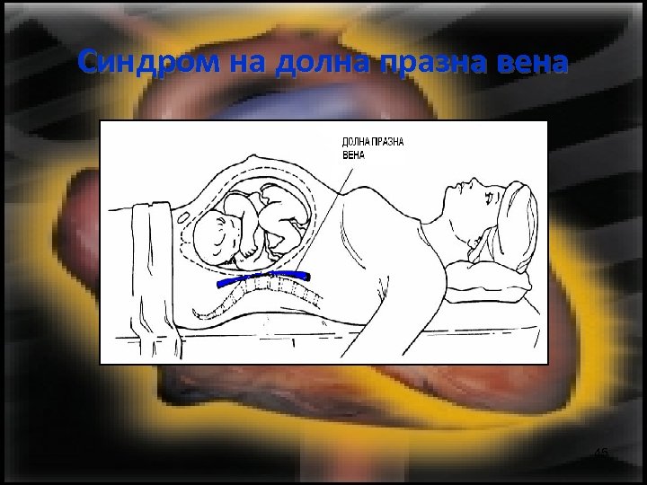 Синдром на долна празна вена 45 