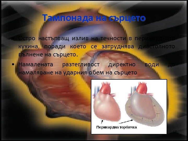 Тампонада на сърцето • Остро настъпващ излив на течности в перикардната кухина, поради което