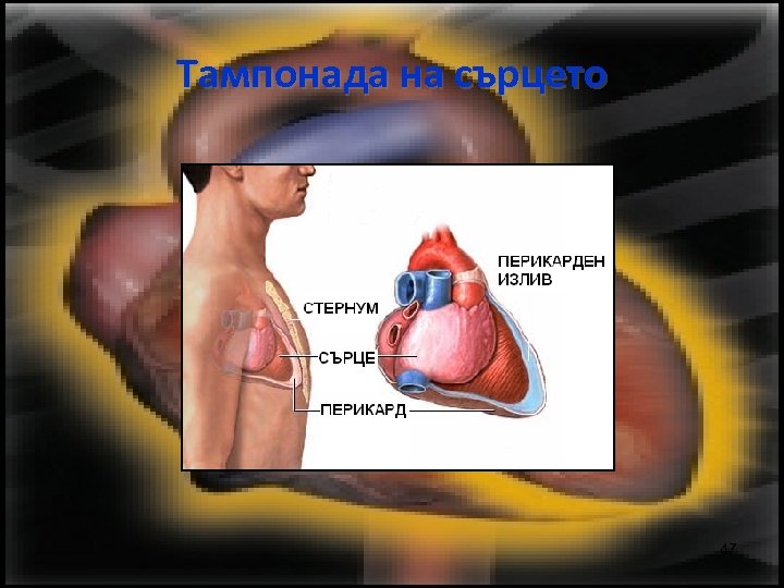 Тампонада на сърцето 47 