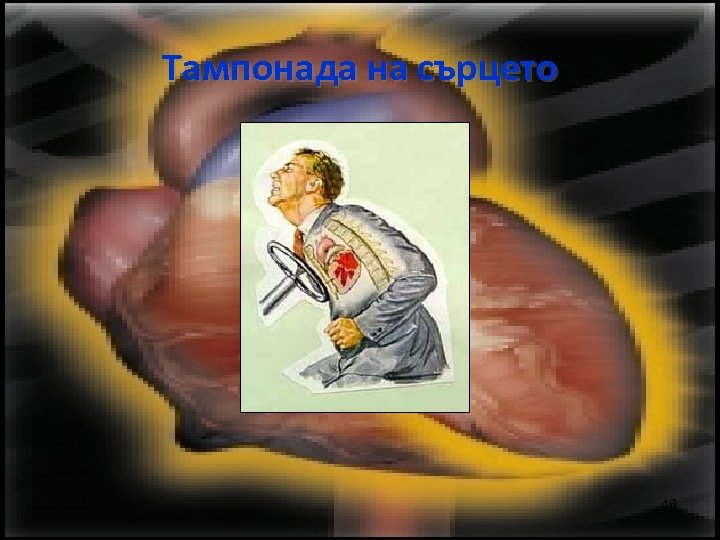 Тампонада на сърцето 48 