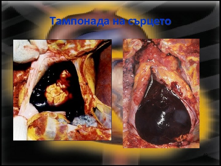 Тампонада на сърцето 49 