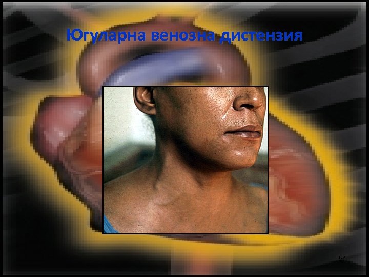 Югуларна венозна дистензия 51 