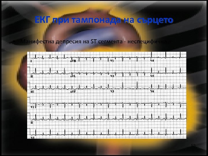 ЕКГ при тампонада на сърцето • Манифестна депресия на ST сегмента - неспецифична 53
