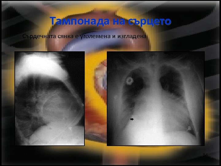 Тампонада на сърцето Сърдечната сянка е уголемена и изгладена 54 