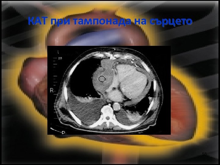 КАТ при тампонада на сърцето 55 