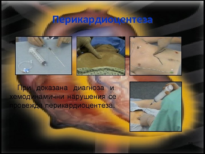 Перикардиоцентеза При доказана диагноза и хемодинамични нарушения се провежда перикардиоцентеза. 58 