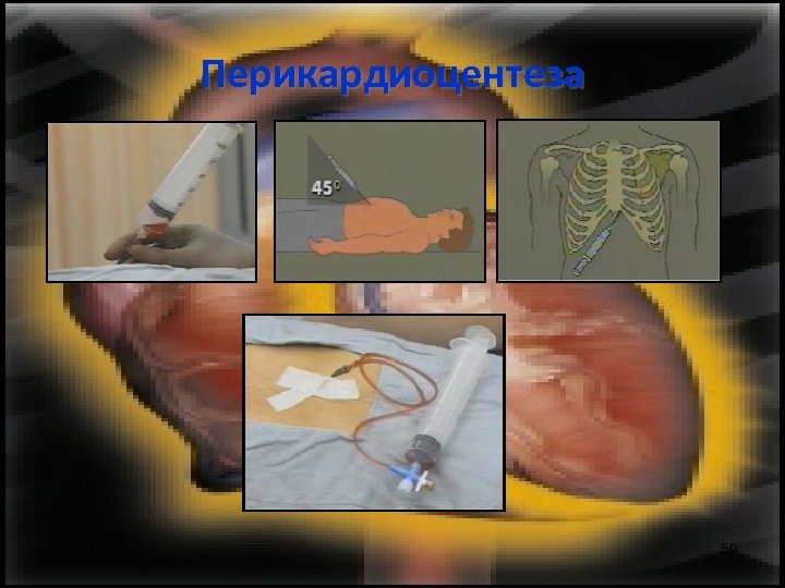 Перикардиоцентеза 59 