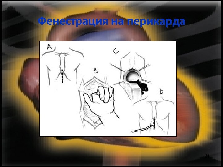 Фенестрация на перикарда 61 