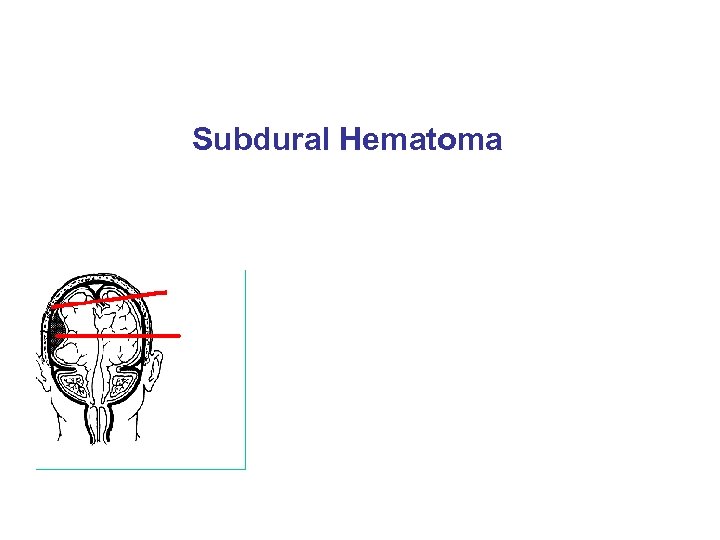 Subdural Hematoma 