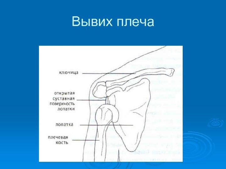 Вывих плеча 