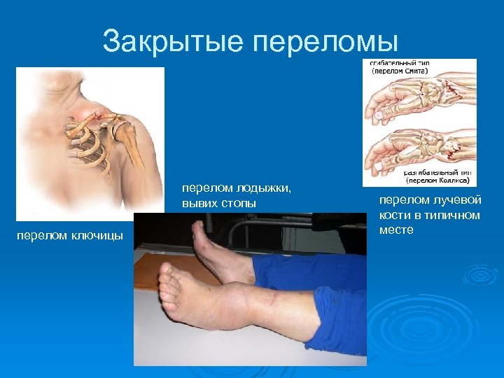 Закрытые переломы перелом лодыжки, вывих стопы перелом ключицы перелом лучевой кости в типичном месте