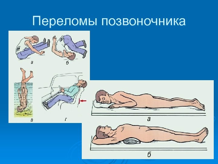 Переломы позвоночника 