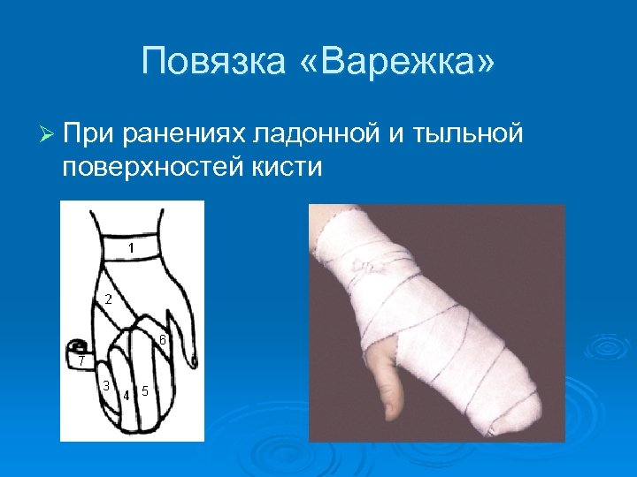 Повязка «Варежка» Ø При ранениях ладонной и тыльной поверхностей кисти 