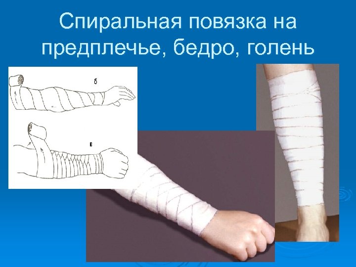 Спиральная повязка на предплечье, бедро, голень 