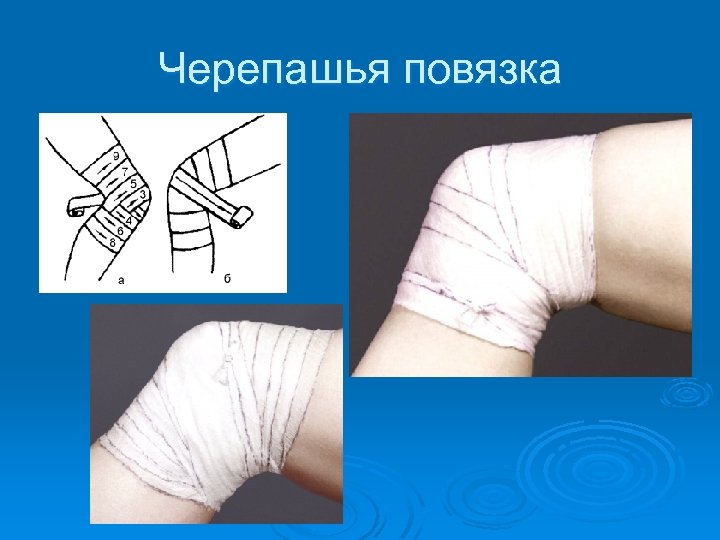 Черепашья повязка 