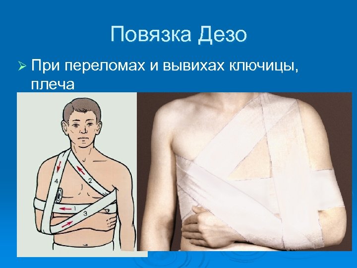 Повязка Дезо Ø При переломах и вывихах ключицы, плеча 