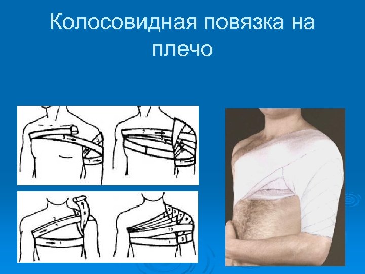 Колосовидная повязка на плечо 