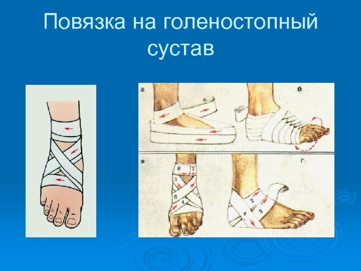 Повязка на голеностопный сустав 