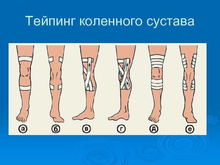 Тейпинг коленного сустава 