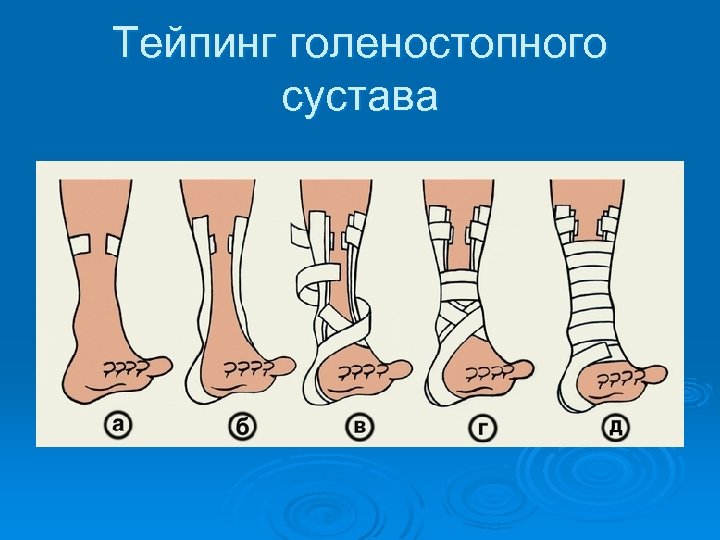Тейпинг голеностопного сустава 