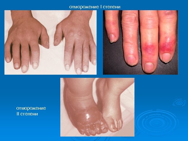 отморожение I степени отморожение II степени 