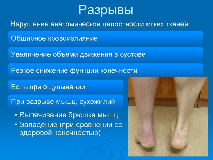 Разрывы Нарушение анатомической целостности мгких тканей Обширное кровоизлияние Увеличение объема движения в суставе Резкое