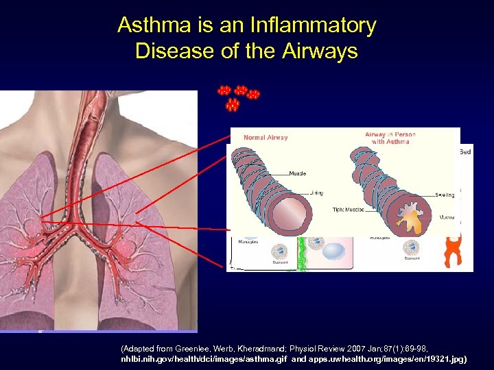 Asthma is an Inflammatory Disease of the Airways (Adapted from Greenlee, Werb, Kheradmand; Physiol