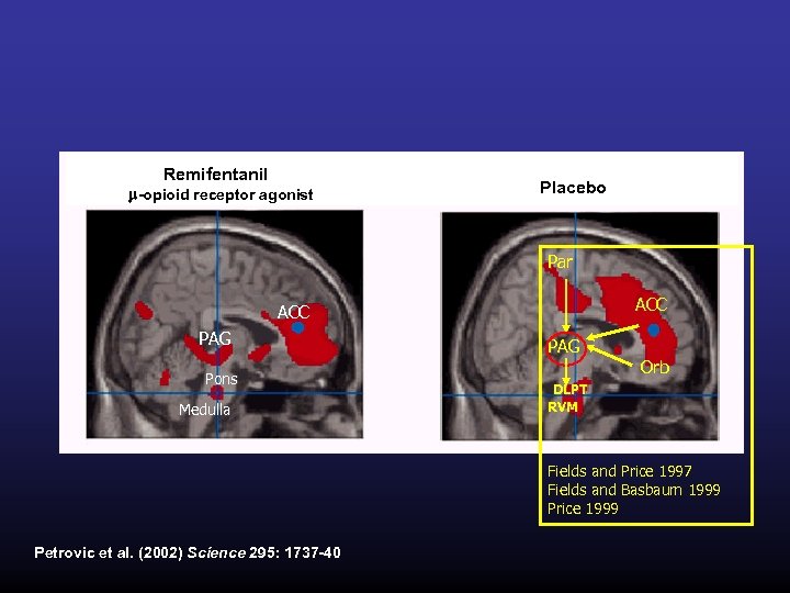 Remifentanil m-opioid receptor agonist Placebo Par ACC PAG Pons Medulla PAG Orb DLPT RVM