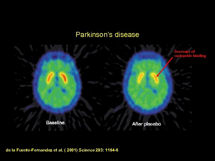 Parkinson’s disease Decrease of raclopride binding de la Fuente-Fernandez et al. ( 2001) Science