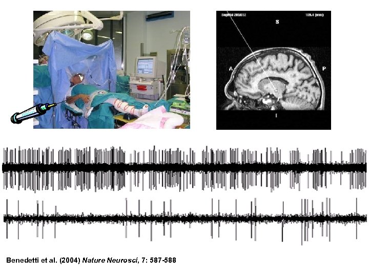 Benedetti et al. (2004) Nature Neurosci, 7: 587 -588 