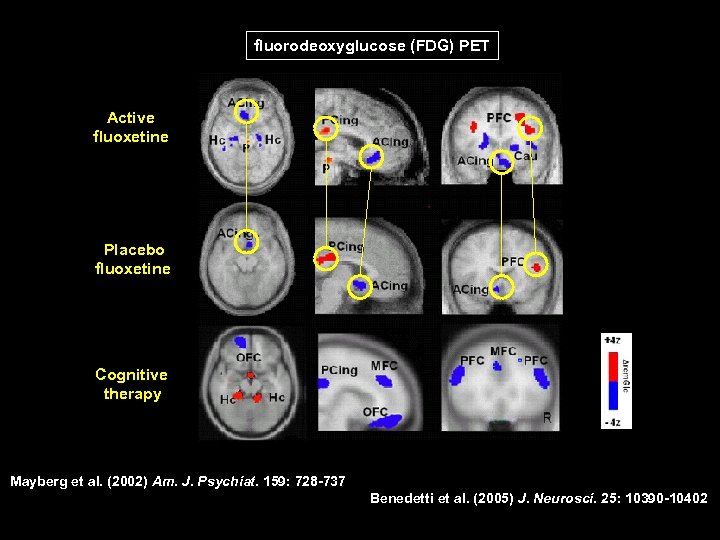 fluorodeoxyglucose (FDG) PET Active fluoxetine Placebo fluoxetine Cognitive therapy Mayberg et al. (2002) Am.