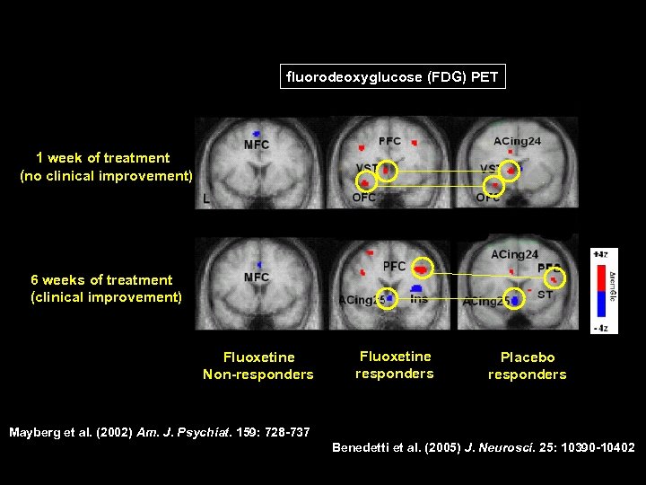 fluorodeoxyglucose (FDG) PET 1 week of treatment (no clinical improvement) 6 weeks of treatment