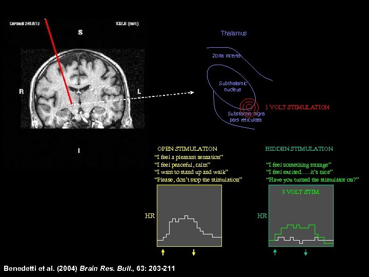 Thalamus Zona incerta Subthalamic nucleus Substantia nigra pars reticulata OPEN STIMULATION “I feel a