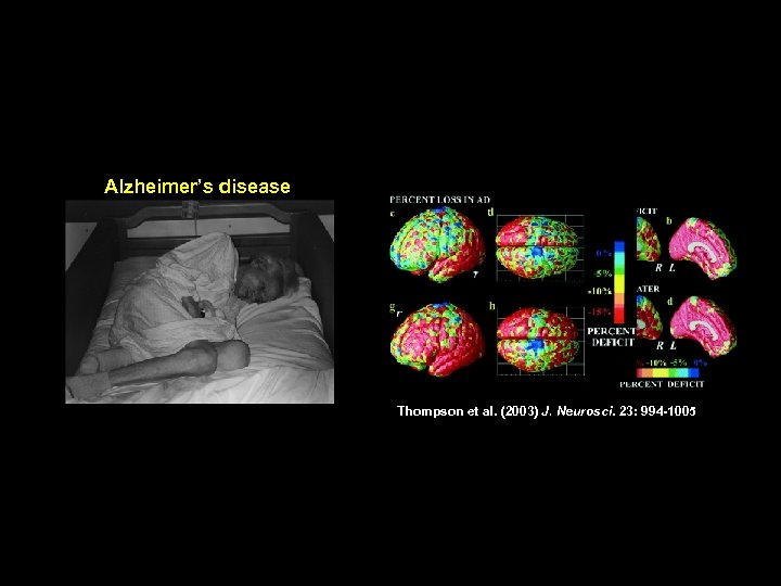 Alzheimer’s disease Thompson et al. (2003) J. Neurosci. 23: 994 -1005 