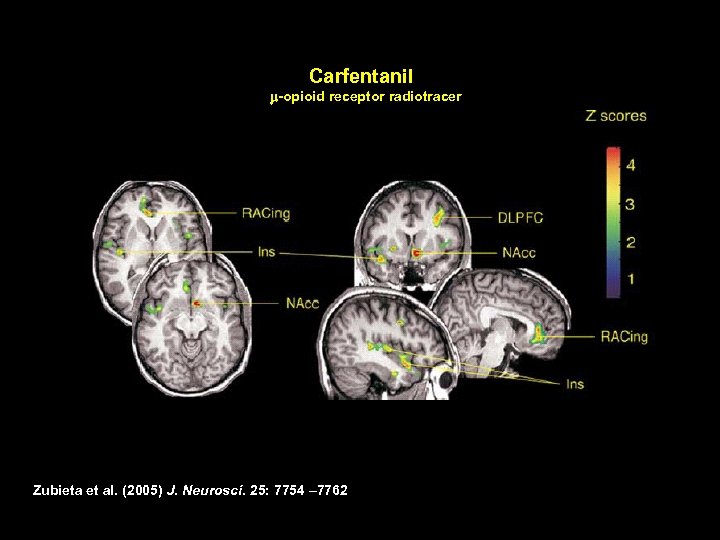 Carfentanil m-opioid receptor radiotracer Zubieta et al. (2005) J. Neurosci. 25: 7754 – 7762