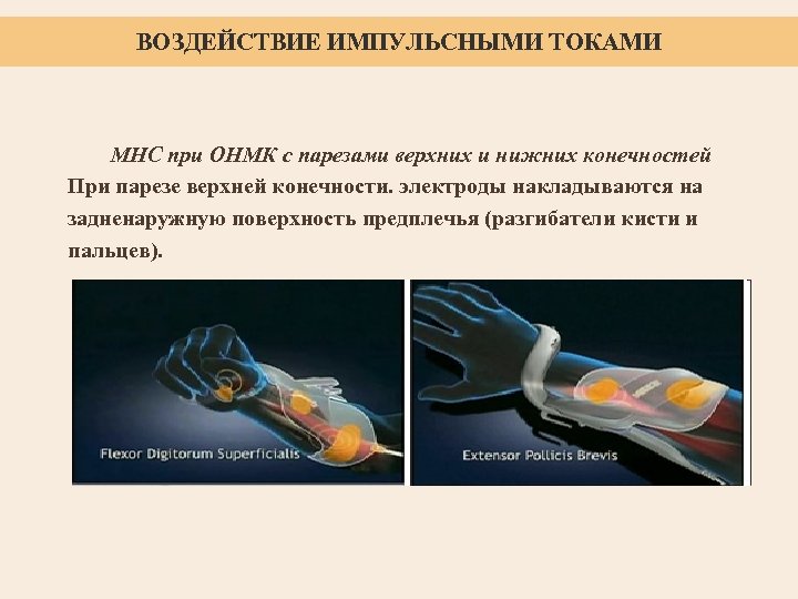 ВОЗДЕЙСТВИЕ ИМПУЛЬСНЫМИ ТОКАМИ МНС при ОНМК с парезами верхних и нижних конечностей При парезе