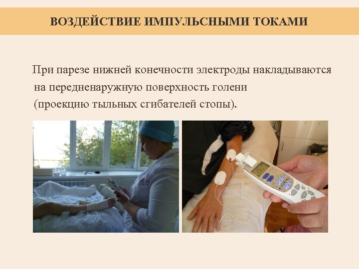 ВОЗДЕЙСТВИЕ ИМПУЛЬСНЫМИ ТОКАМИ При парезе нижней конечности электроды накладываются на передненаружную поверхность голени (проекцию
