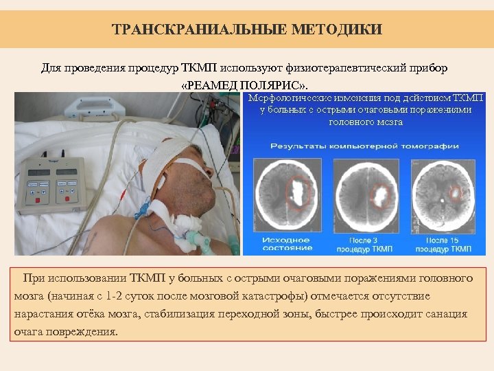  ТРАНСКРАНИАЛЬНЫЕ МЕТОДИКИ Для проведения процедур ТКМП используют физиотерапевтический прибор «РЕАМЕД ПОЛЯРИС» . При