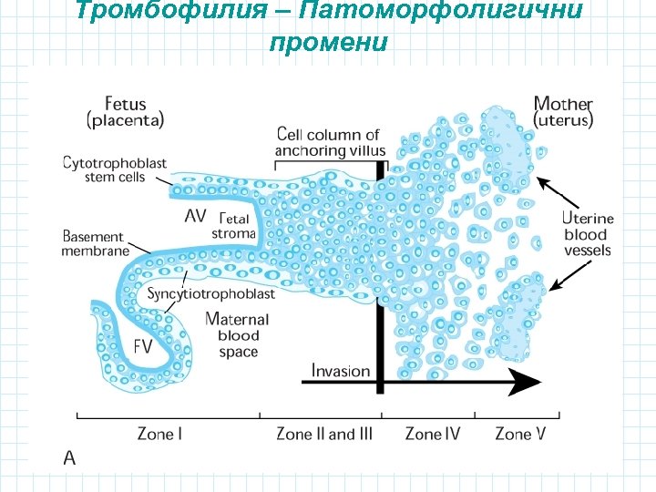 Тромбофилия – Патоморфолигични промени 