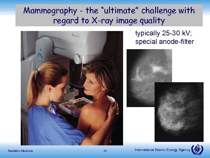 Mammography - the “ultimate” challenge with regard to X-ray image quality typically 25 -30
