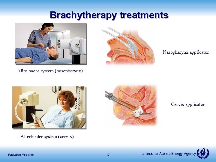 Brachytherapy treatments Nasopharynx applicator Afterloader system (nasopharynx) Cervix applicator Afterloader system (cervix) Radiation Medicine