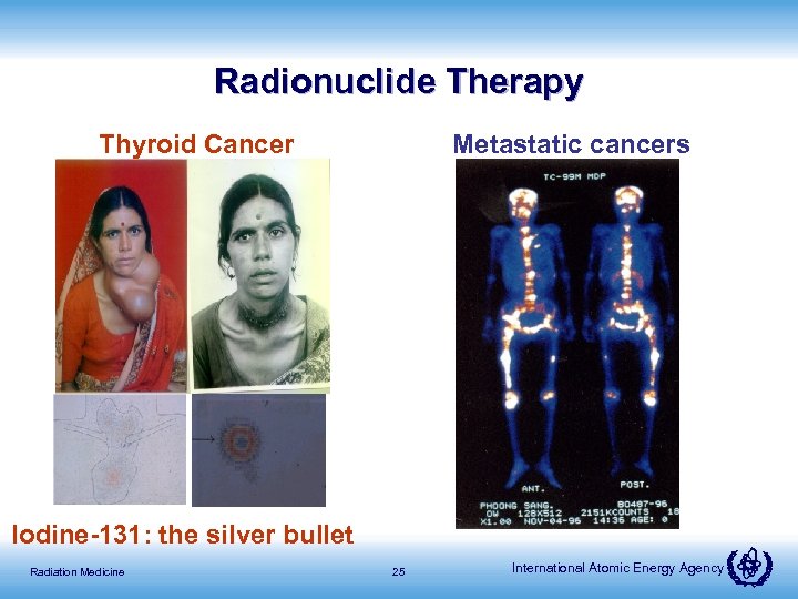 Radionuclide Therapy Thyroid Cancer Metastatic cancers Iodine-131: the silver bullet Radiation Medicine 25 International