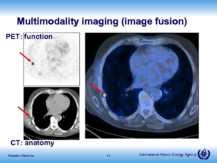 Multimodality imaging (image fusion) PET: function CT: anatomy Radiation Medicine 31 International Atomic Energy