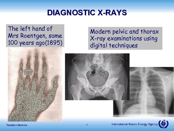 DIAGNOSTIC X-RAYS The left hand of Mrs Roentgen, some 100 years ago(1895) Radiation Medicine