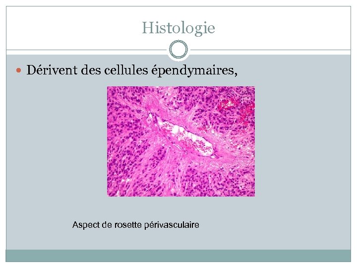 Histologie Dérivent des cellules épendymaires, Aspect de rosette périvasculaire 