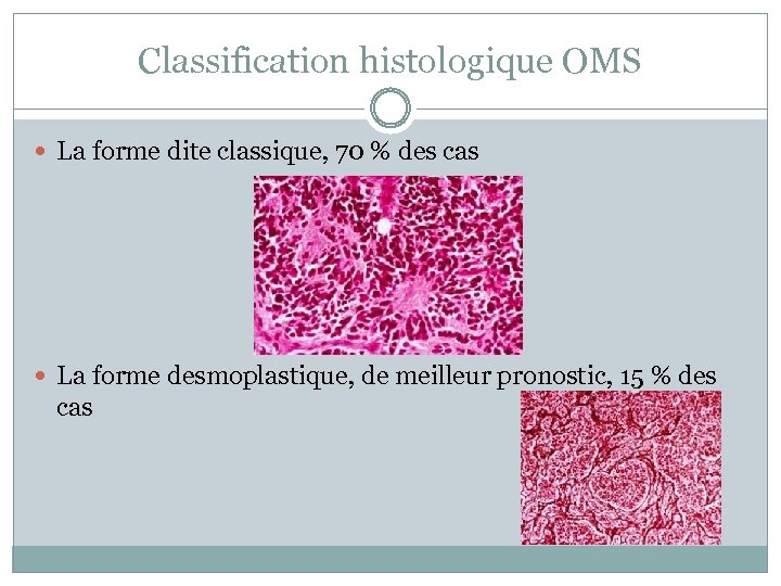 Classification histologique OMS La forme dite classique, 70 % des cas La forme desmoplastique,