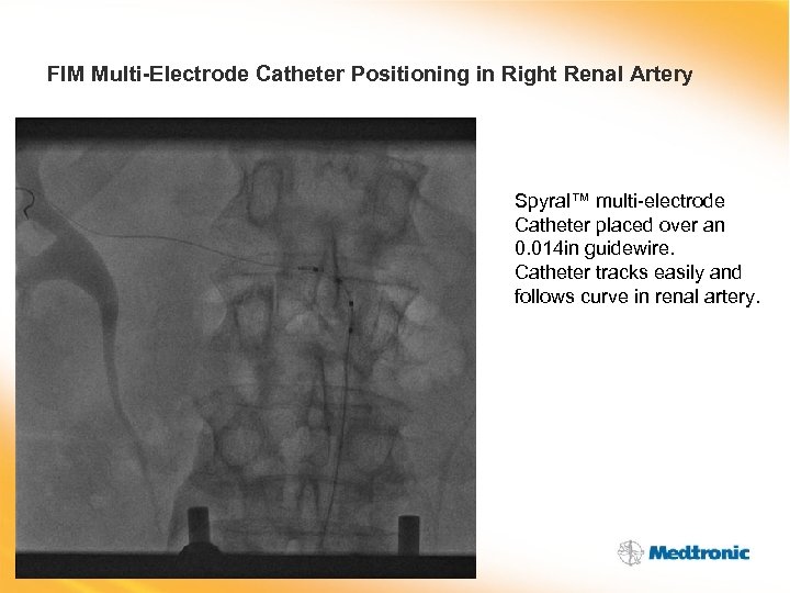 FIM Multi-Electrode Catheter Positioning in Right Renal Artery Spyral™ multi-electrode Catheter placed over an