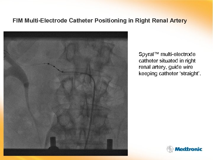 FIM Multi-Electrode Catheter Positioning in Right Renal Artery Spyral™ multi-electrode catheter situated in right