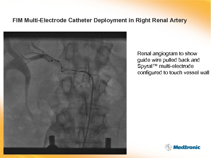 FIM Multi-Electrode Catheter Deployment in Right Renal Artery Renal angiogram to show guide wire