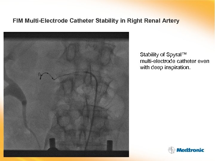 FIM Multi-Electrode Catheter Stability in Right Renal Artery Stability of Spyral™ multi-electrode catheter even